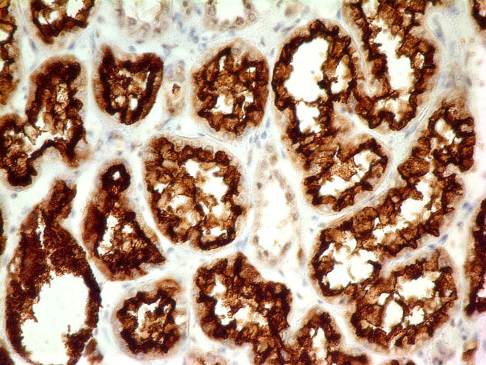 Fig-1: Immunohistochemical analysis of CD10 in human Renal CellCarcinoma tissue using CD10 antibody (Clone: ABM4A52) at 5 µg/ml.